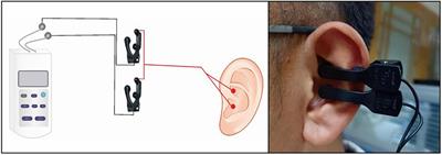 Immediate Modulation of Transcutaneous Auricular Vagus Nerve Stimulation in Patients With Treatment-Resistant Depression: A Resting-State Functional Magnetic Resonance Imaging Study